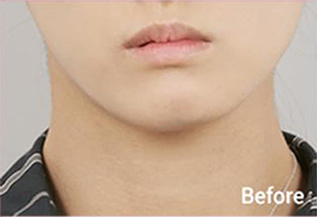 ภาพก่อนและหลังทำ Contour Tox 4 แบบเพื่อผลลัพธ์ V-line