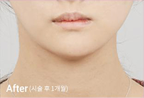 ภาพก่อนและหลังทำ Contour Tox 4 แบบเพื่อผลลัพธ์ V-line