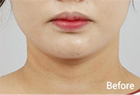 ภาพก่อนและหลังทำ Contour Tox 4 แบบเพื่อผลลัพธ์ V-line