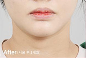 ภาพก่อนและหลังทำ Contour Tox 4 แบบเพื่อผลลัพธ์ V-line