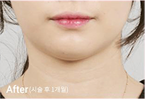 ภาพก่อนและหลังทำ Contour Tox 4 แบบเพื่อผลลัพธ์ V-line