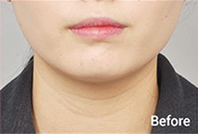 ภาพก่อนและหลังทำ Contour Tox 4 แบบเพื่อผลลัพธ์ V-line
