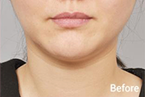 ภาพก่อนและหลังทำ Contour Tox 4 แบบเพื่อผลลัพธ์ V-line