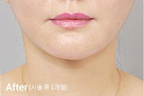 ภาพก่อนและหลังทำ Contour Tox 4 แบบเพื่อผลลัพธ์ V-line