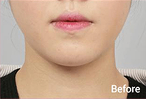 ภาพก่อนและหลังทำ Contour Tox 4 แบบเพื่อผลลัพธ์ V-line